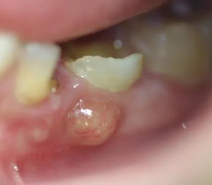 Abces dentar (infectie dentara)