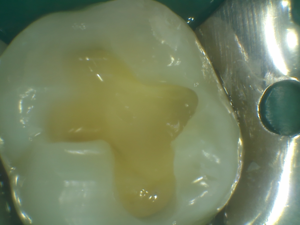 Aplicarea compozitului fluid